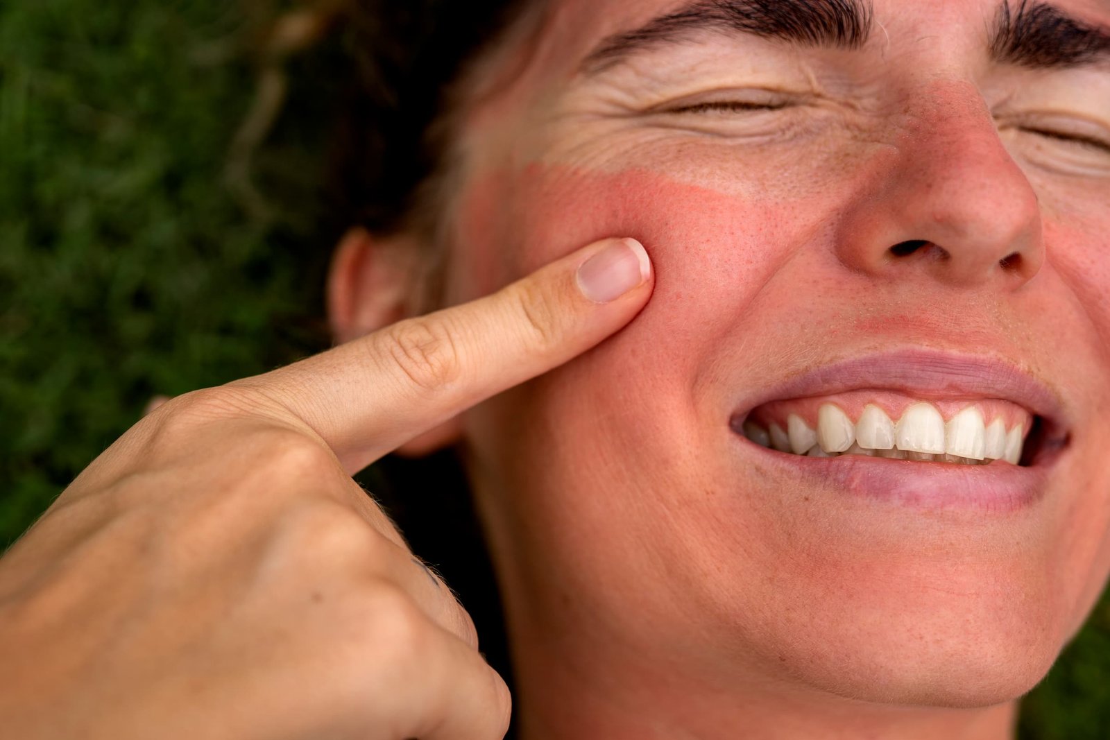 portrait-adult-woman-with-sunburn-skin (1)
